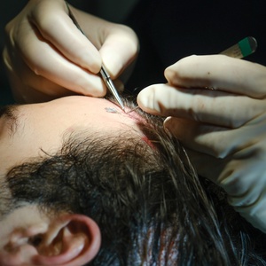 L'implantation