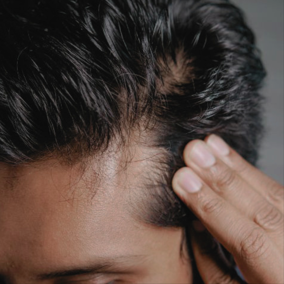 Greffe de cheveux FUE Paris