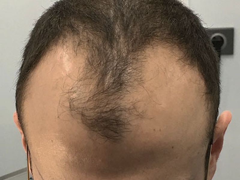 Greffe de cheveux cas 3.1 homme av
