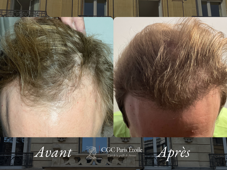 Avant / Après transplantation capillaire FUE homme