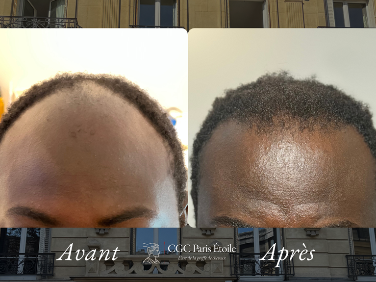 Résultat greffe de cheveux crépus homme