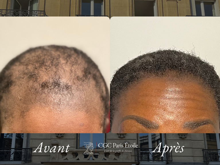 Greffe de cheveux crépus Paris