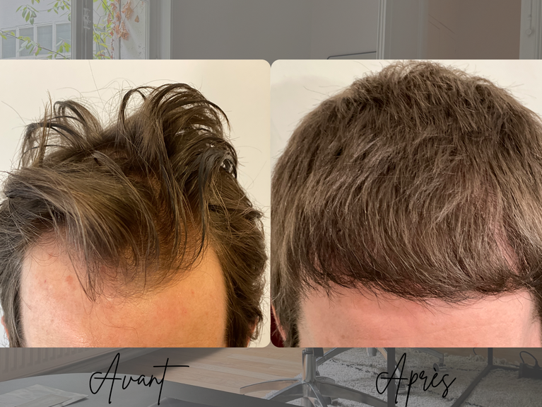 Avant après greffe de cheveux FUE homme