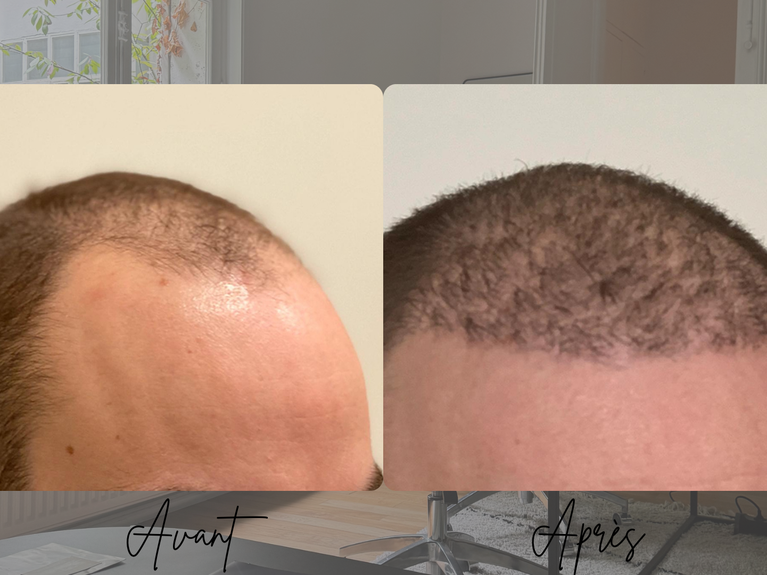 Résultat transplantation capillaire FUE homme