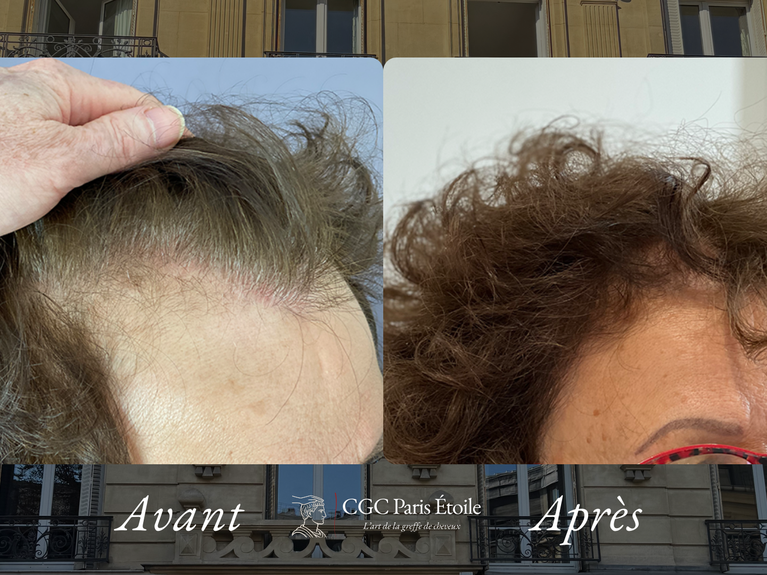 Résultat greffe cheveux FUT femme