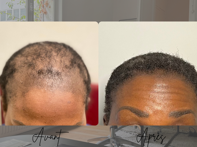 Avant après greffe de cheveux crépus FUT femme