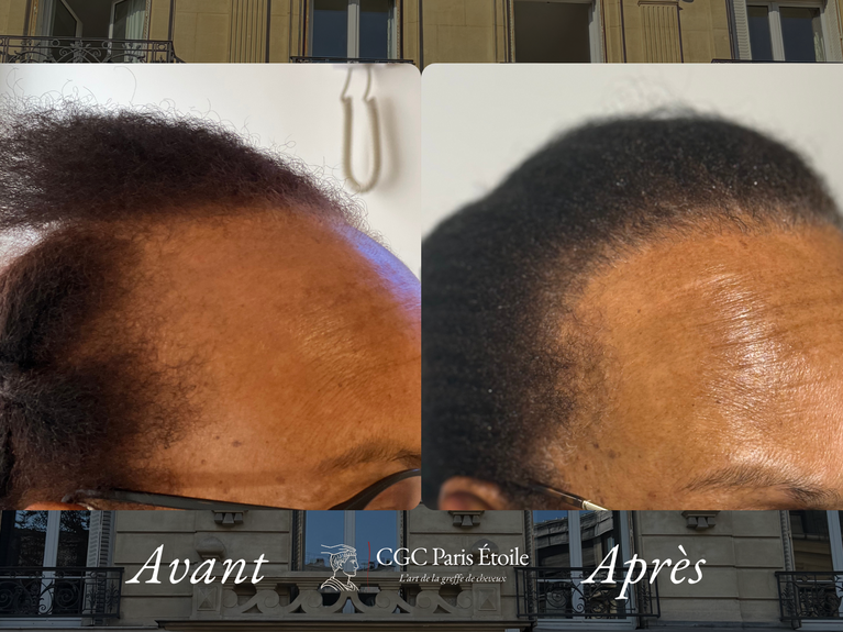 Avant / Après greffe cheveux FUT femme