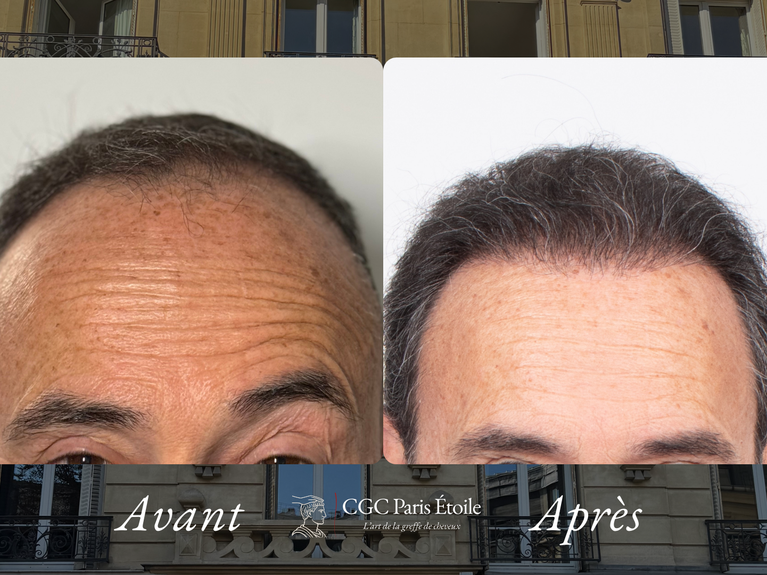Greffe de cheveux FUE Paris