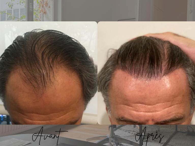 Avant après greffe de cheveux FUT homme