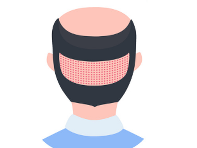 FUE : Follicular Hair Extraction
