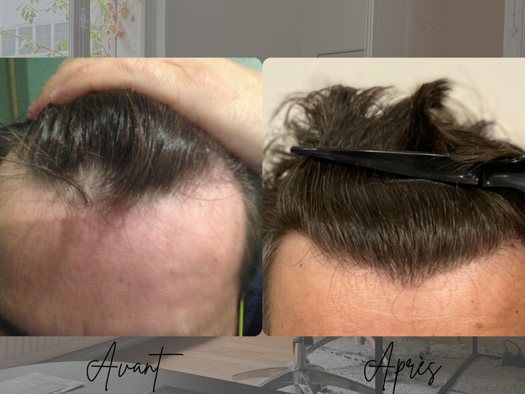 Résultat greffe de cheveux FUT