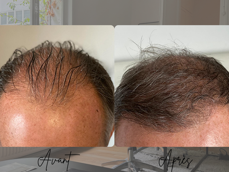 Résultat transplantation capillaire FUT homme
