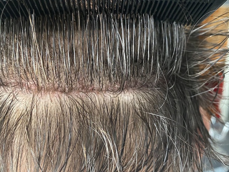 Greffe de cheveux FUT la cicatrice