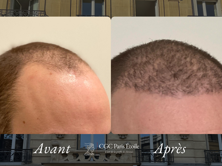 Implants capillaires FUE Paris