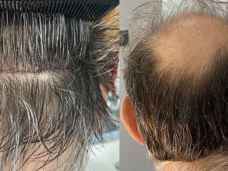 Cicatrice technique FUT