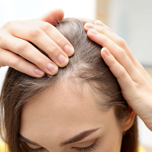 La greffe de cheveux