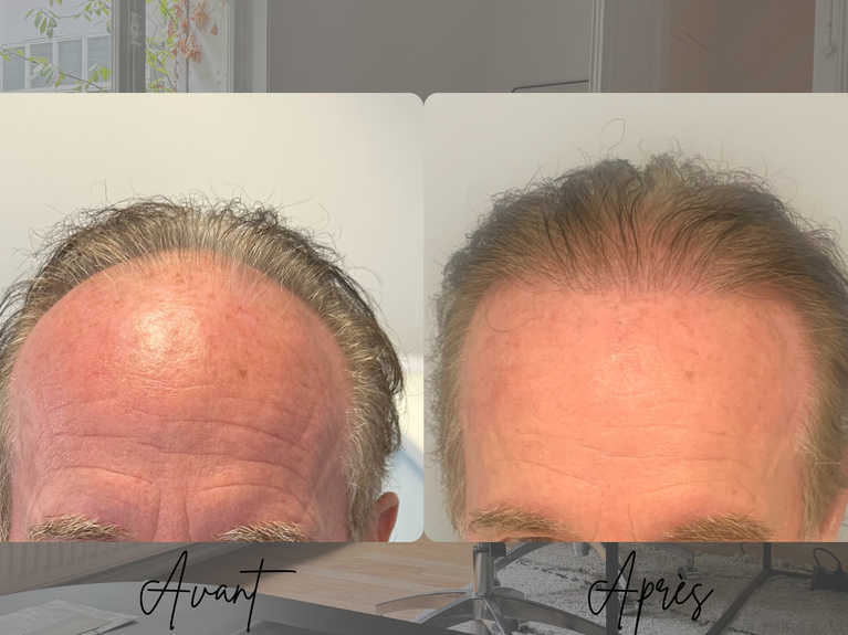 Greffe de cheveux FUE 3