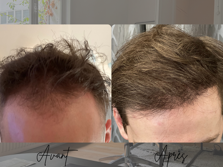 Avant après greffe de cheveux FUE homme