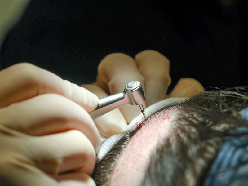 FUE : Follicular Unit Extraction