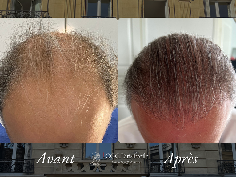 Avant / Après transplantation capillaire FUT homme
