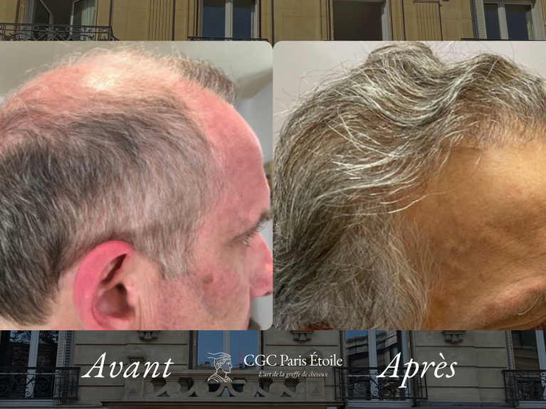 Avant / Après greffe de cheveux FUE homme