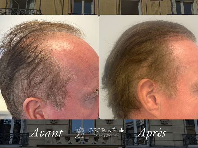 Résultat greffe cheveux FUE homme