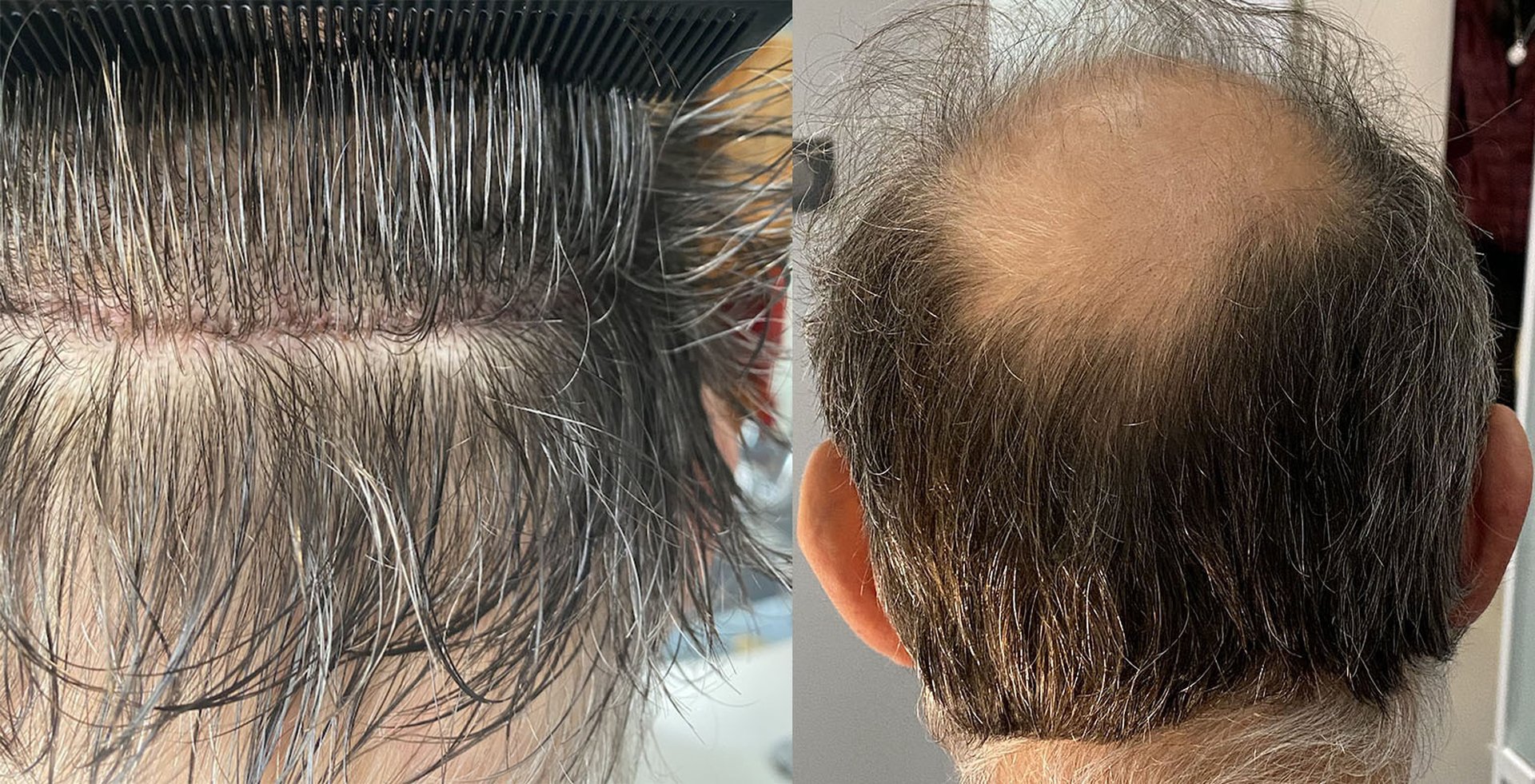 Cicatrice technique FUT