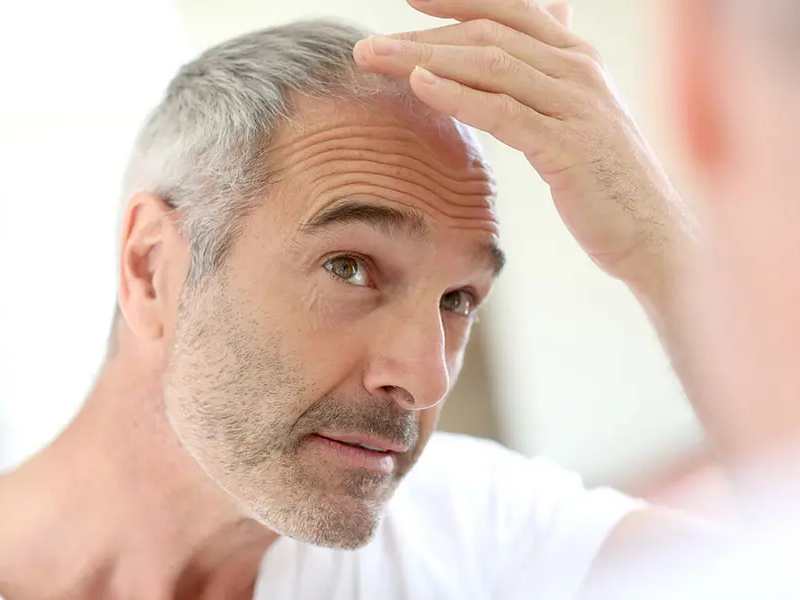 La greffe de cheveux