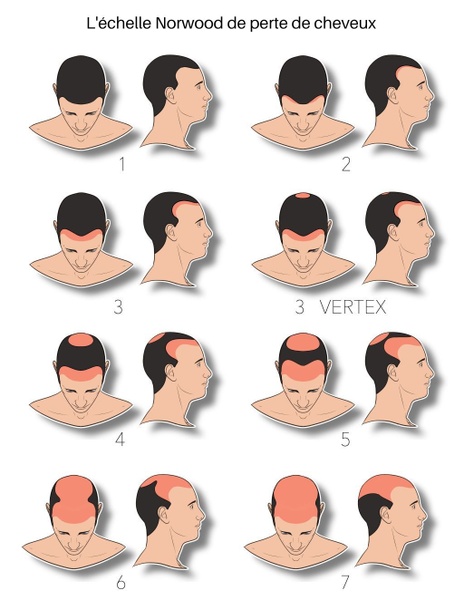 Stades de perte de cheveux hommes