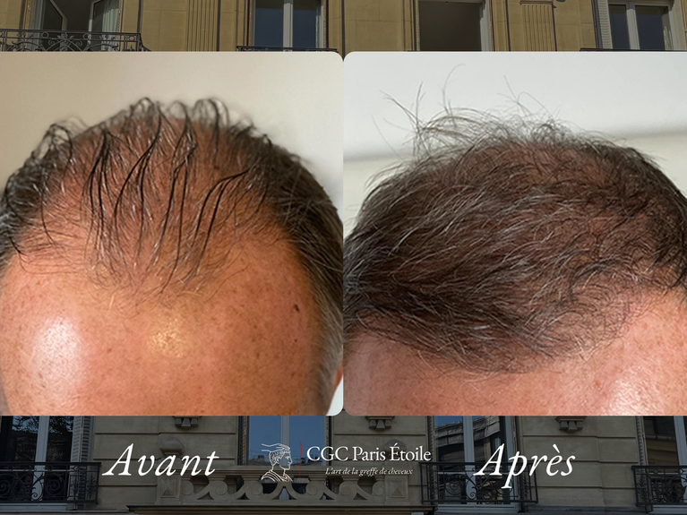 Résultat transplantation capillaire FUE homme