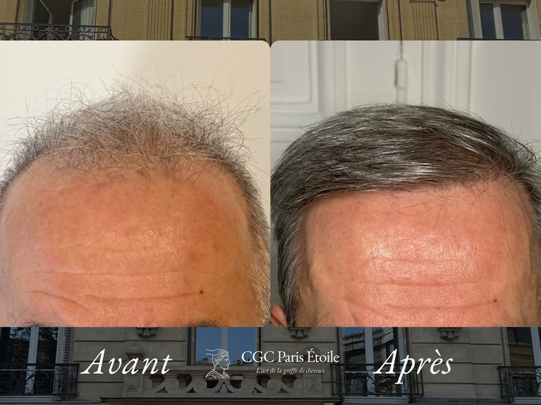 Résultat greffe FUE homme