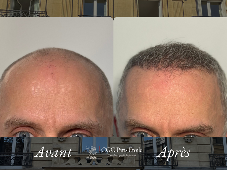 Implants capillaires hommes Paris