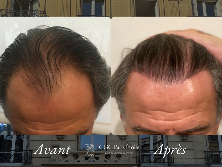 Avant / Après greffe cheveux FUT homme