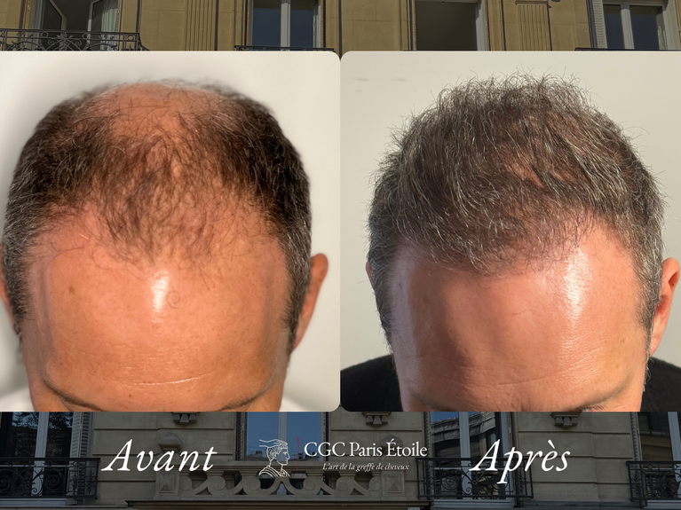 Greffe de cheveux FUE Paris