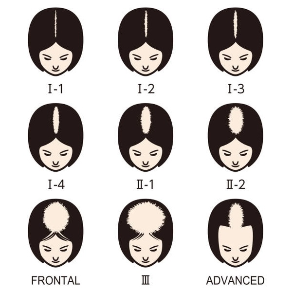 Stades de perte de cheveux femmes