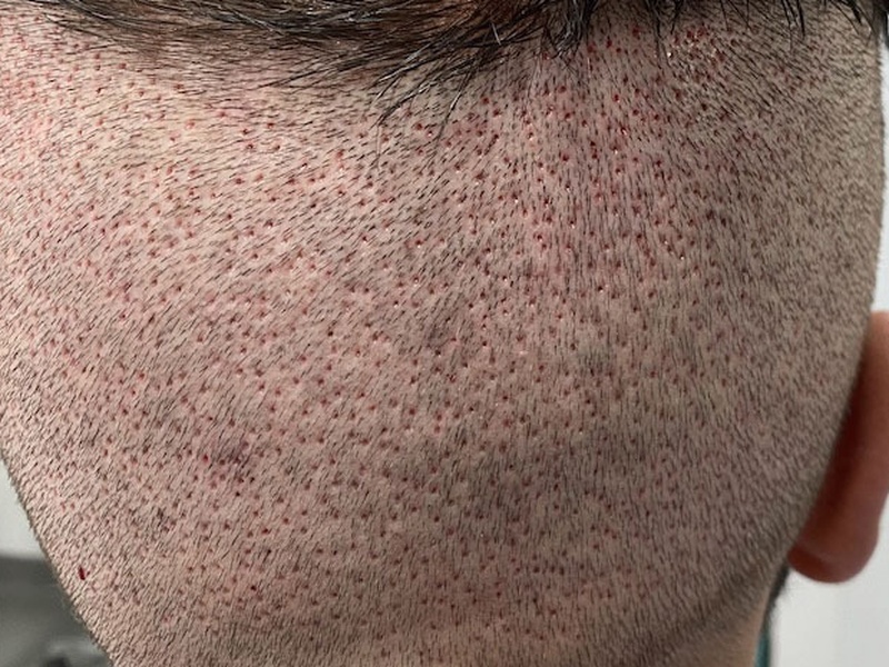 Implants de cheveux FUE "aspect post op"