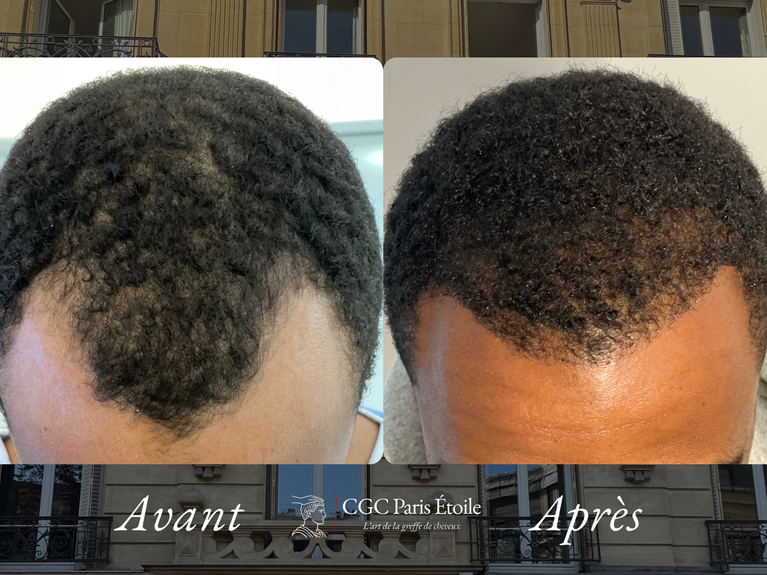 Greffe de cheveux crépus Paris