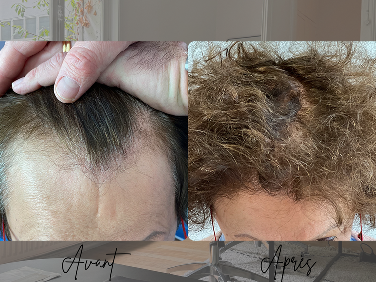 Résultat greffe de cheveux femme FUT