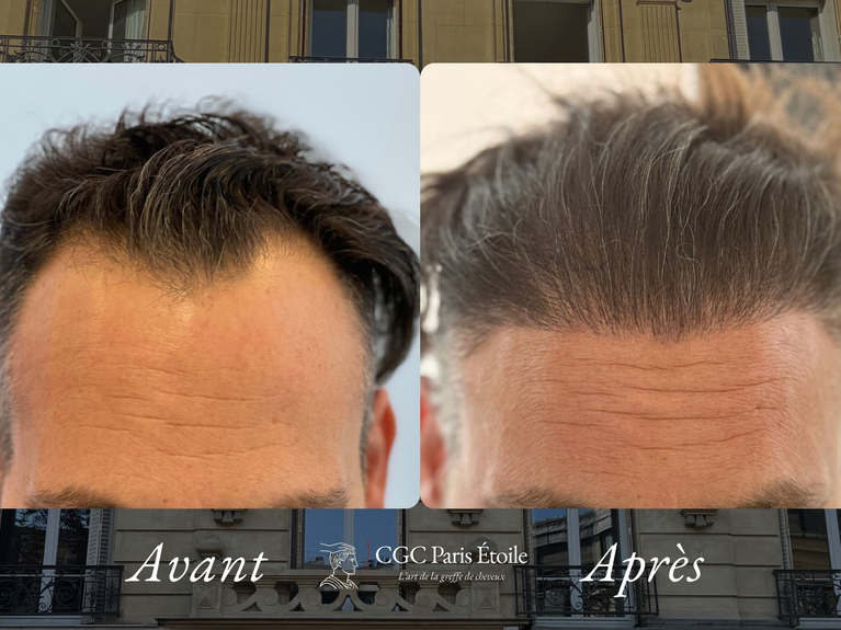 Résultat greffe capillaire FUE homme