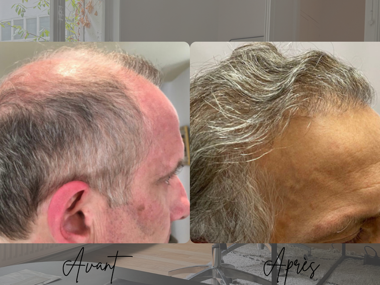 Résultat transplantation capillaire FUT homme