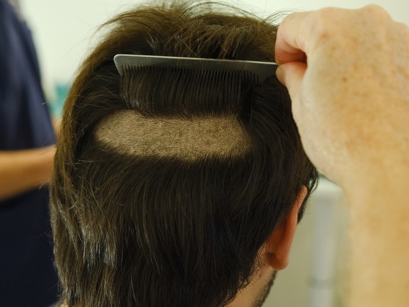 Rasage complet de la zone donneuse