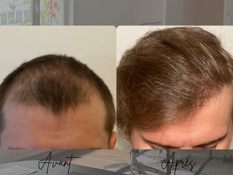 Avant après greffe de cheveux FUE