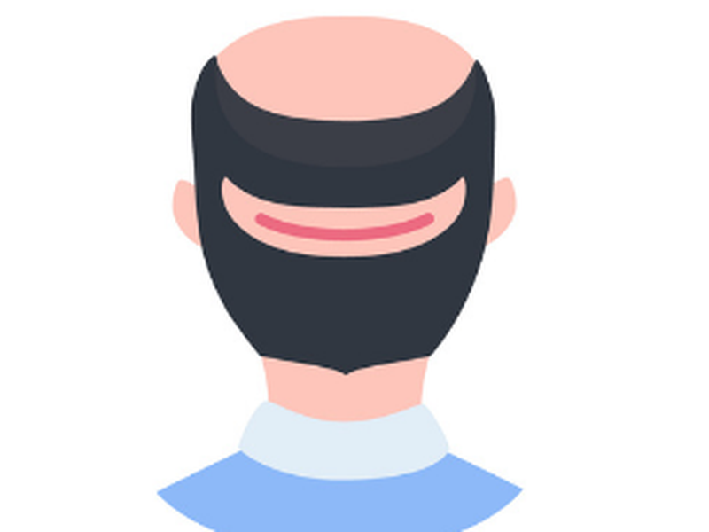 FUT : Follicular Hair Transplant