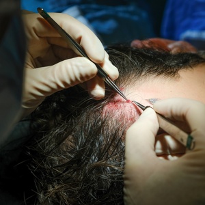 L'implantation