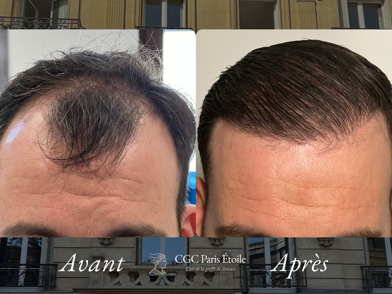 Greffe de cheveux Paris
