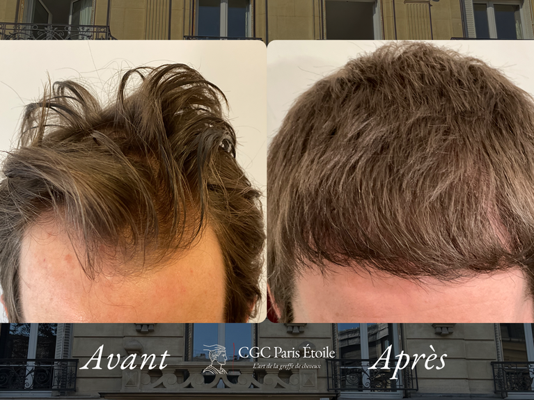 Avant / Après greffe de cheveux FUE homme