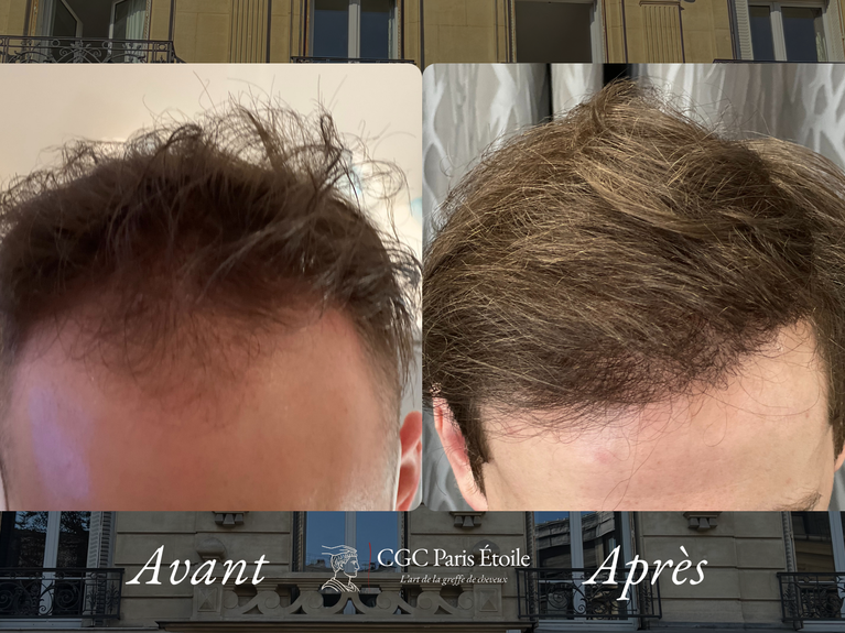 Greffe cheveux Paris