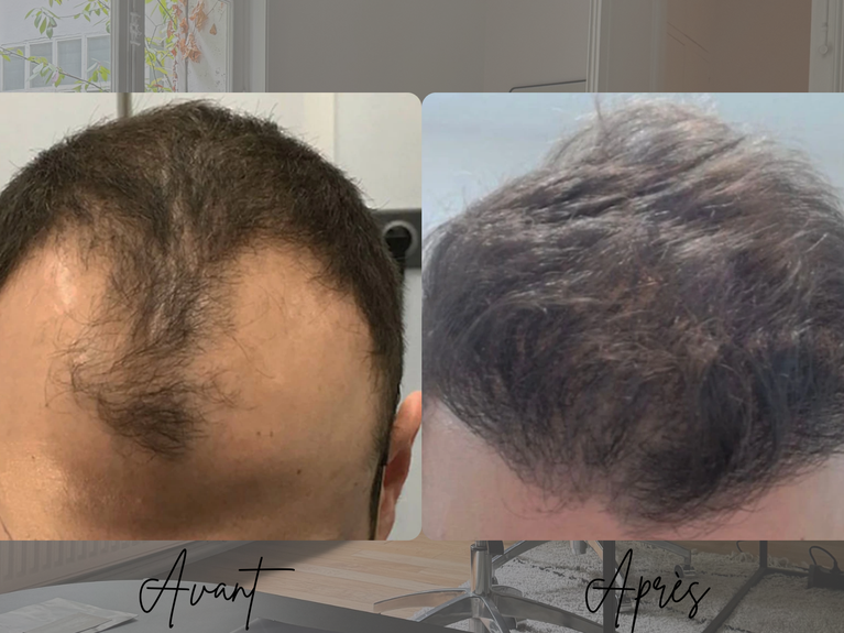 Avant après greffe de cheveux FUE homme