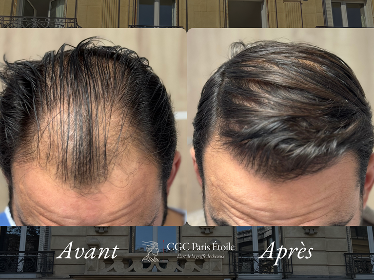 Résultat greffe de cheveux FUE homme