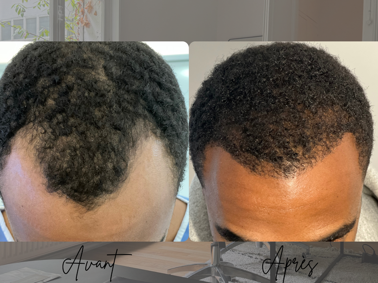 Transplantation de cheveux crépus FUE 2